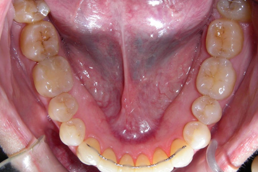 Ortodoncia invisible (Invisalign). Clase I y apiñamiento