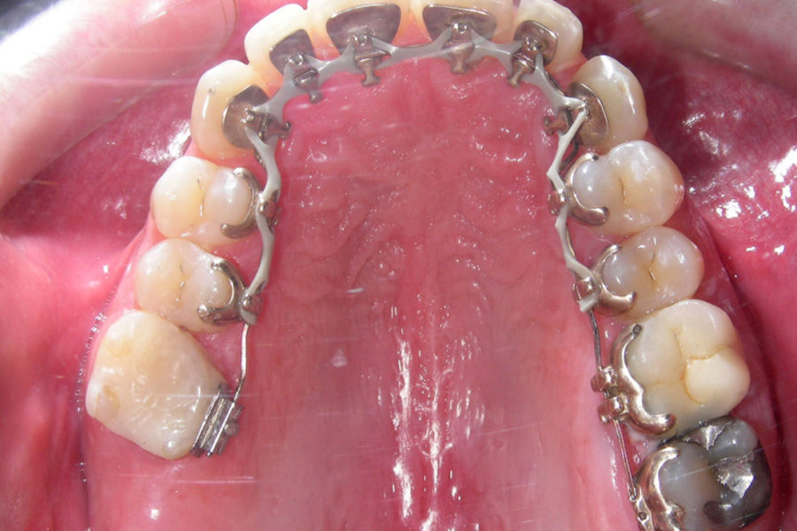 Ortodoncia lingual. Clase I y mordida cruzada canino inferior derecho