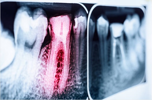¿Qué es una endodoncia y en qué consiste?